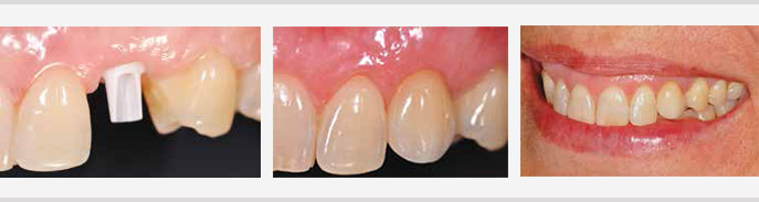 canine incluse implant trans-corono-radiculaire