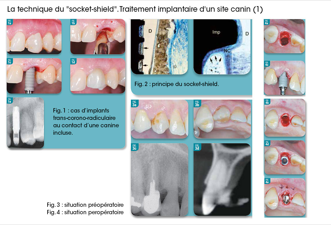 socket shield