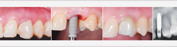 cas d’implants trans-corono-radiculaire au contact d’une canine incluse