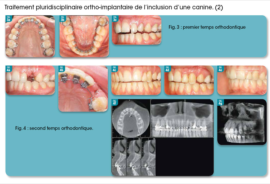 traitement des cas d’inclusion
de la canine maxillaire