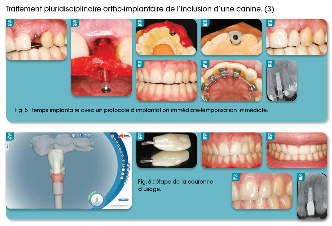 premier temps orthodontique
