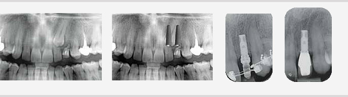 Traitement pluridisciplinaire ortho-implantaire de l'inclusion d’une canine