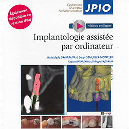 implantologie assistée par ordinateur