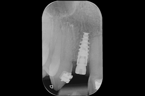 radiographie de contrôle postopératoire.