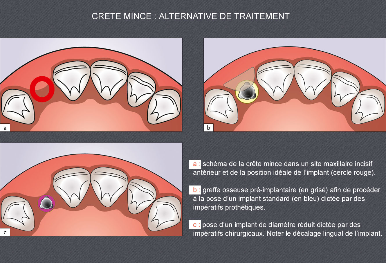 crête alvéolaire mince