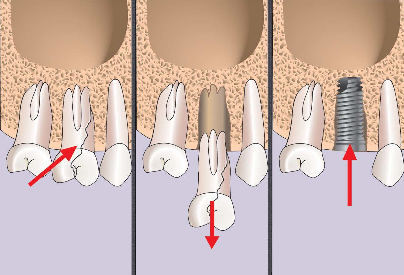implant dentaire gros diamètre