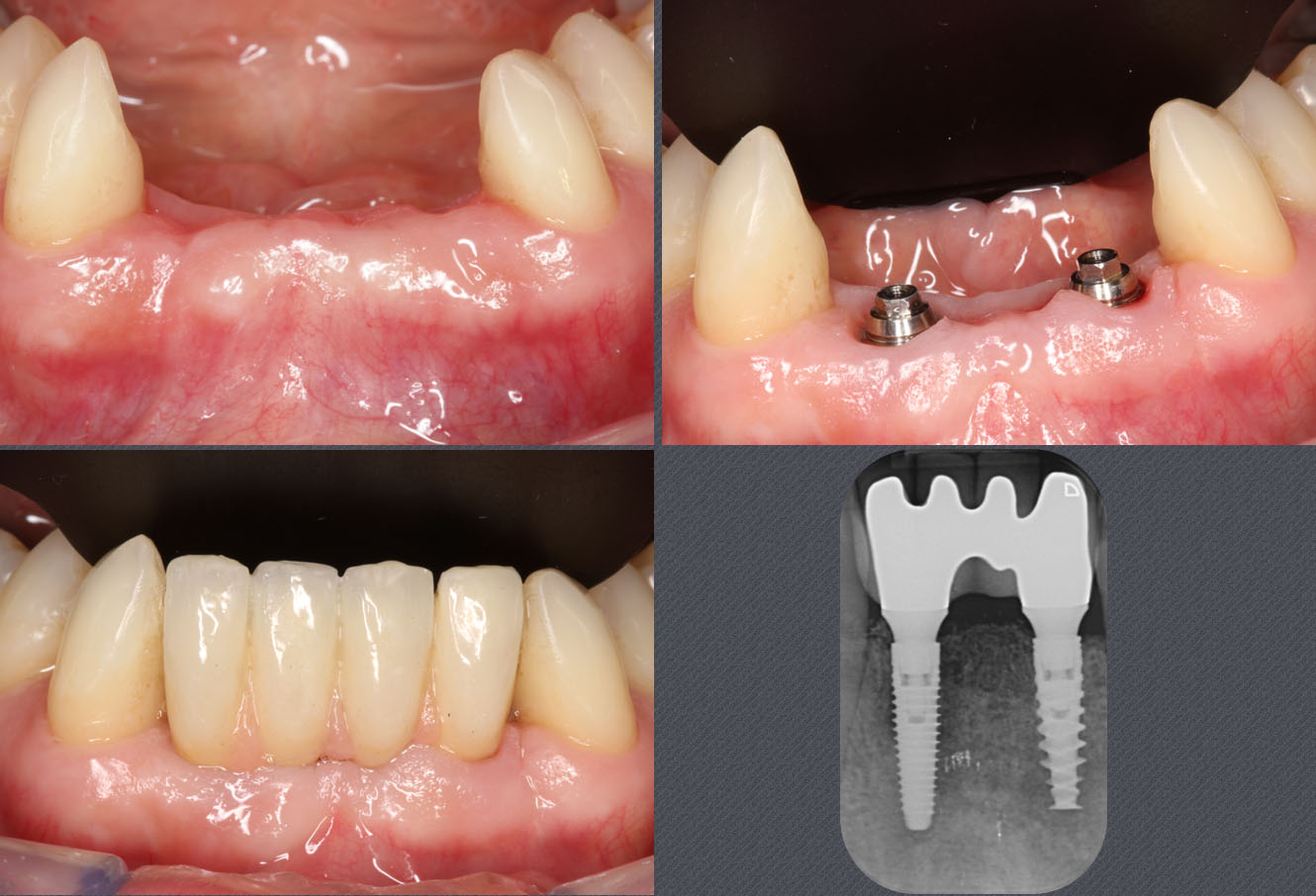 implant de diamètre réduit