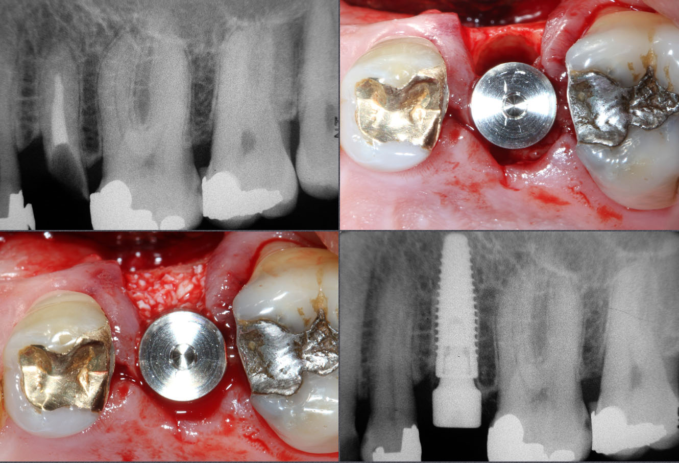 implants coniques