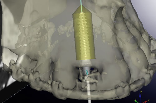 simulation implant