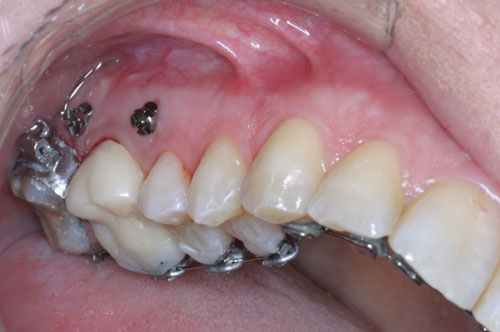 bagues orthodontiques et  minivis