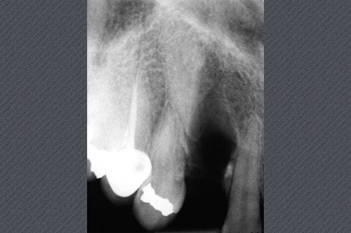 radiographie avant la pose de l'implant dentaire