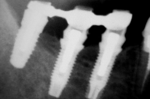radiographie des piliers et du bridge