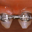 implants pour les seniors
