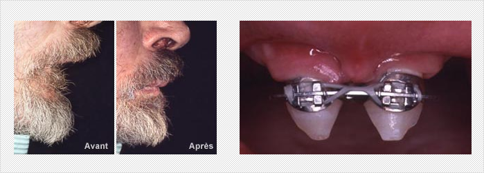 implant