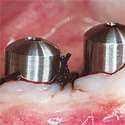 implant dentaire titane