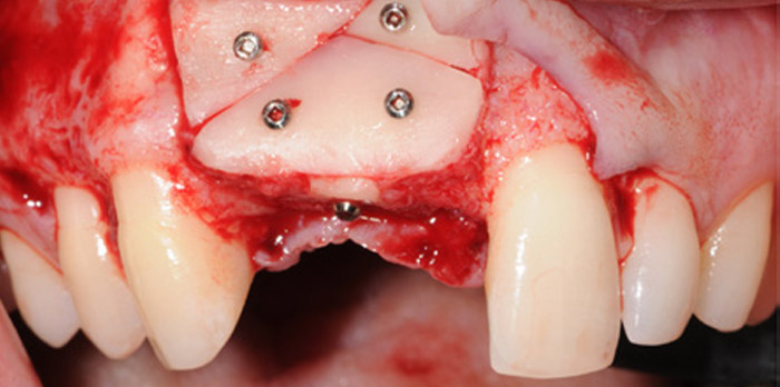 augmentation verticale