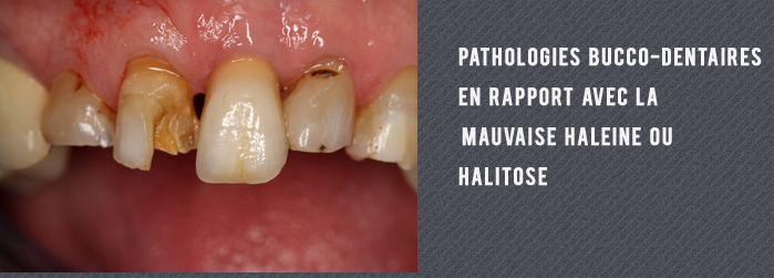 pathologies bucco dentaires