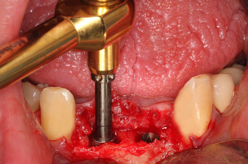 implants NobelActive