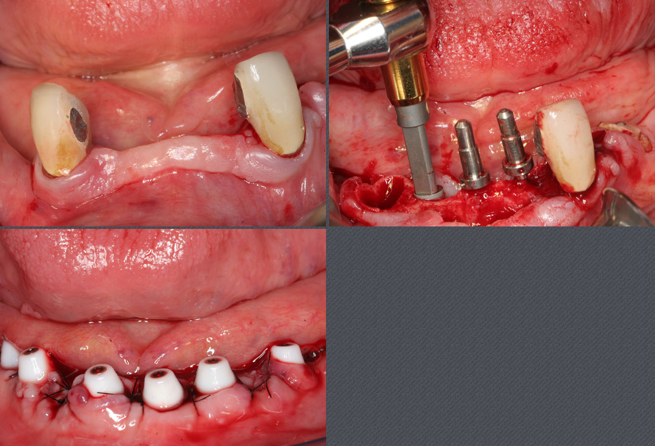 prothèse sur implant