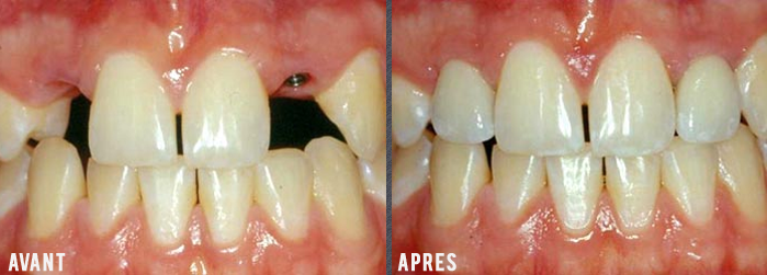 prothese dentaire  implanto portée