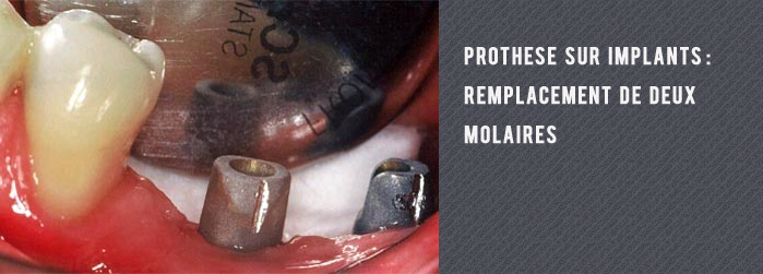 prothèse sur implant