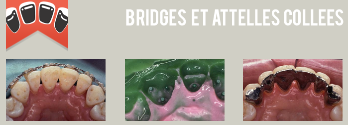 bridge dentaire