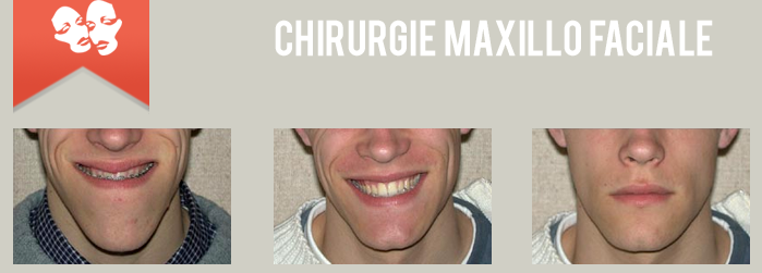 chirurgie maxillo faciale