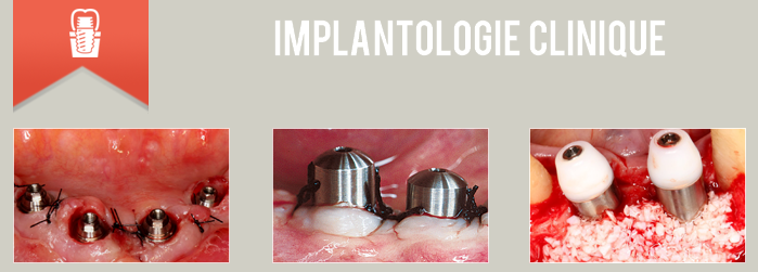 implant dentaire