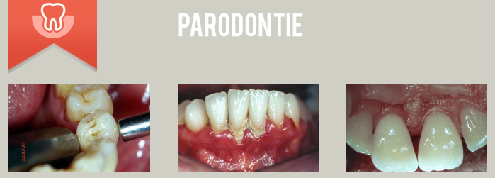 parodontie