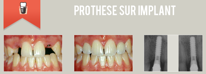 prothese sur implant